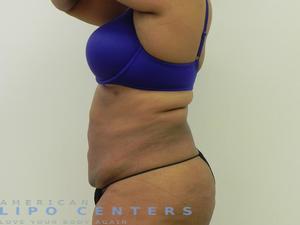 americanlipocenters_1711.jpg